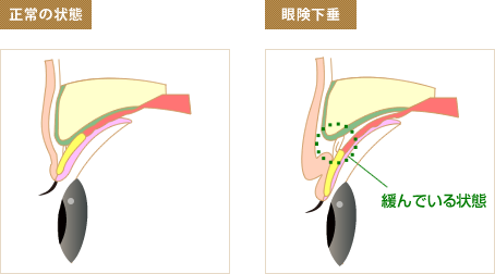 眼瞼下垂