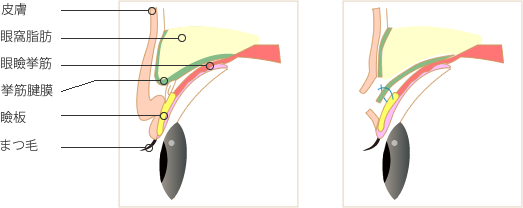 眼瞼下垂の重症度