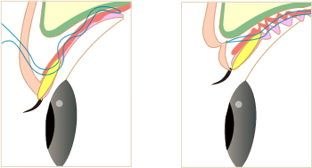 眼瞼下垂の重症度